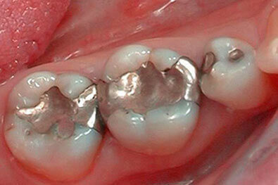 Three teeth with large metal fillings