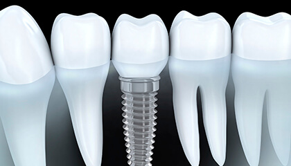 Animation of dental implant supported crown