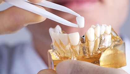 Model of dental implant supported crown