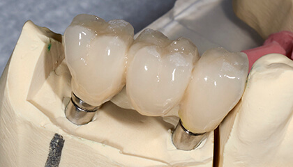 Model of dental implant supported fixed bridge
