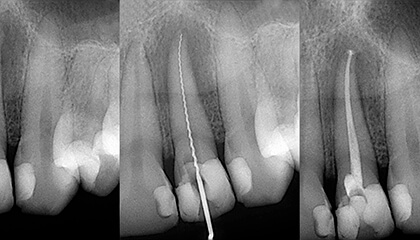 X-rays of root canal treatment process