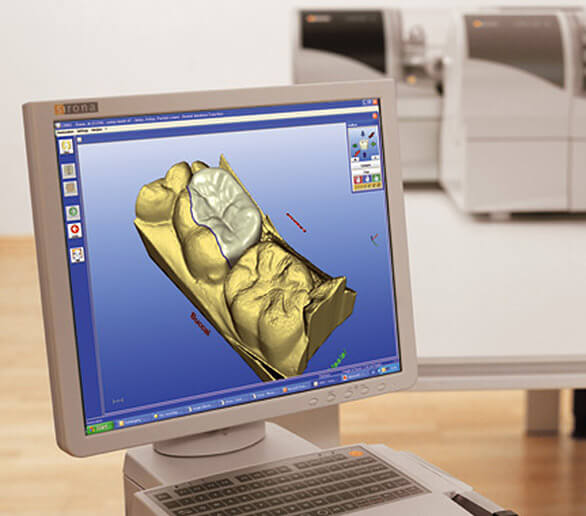 Computer screen showing digital model of dental crown