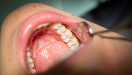 Smile examined assessed following restoration