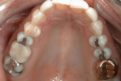 Tooth with worn metal dental crown