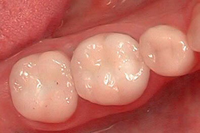 Teeth repaired with tooth-colored restorations