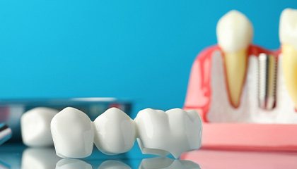 Sample dental bridge and model dental implant on reflective surface with light blue background