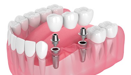 Illustration of an implant bridge
