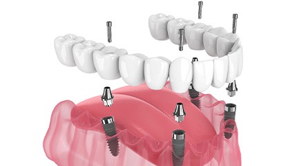 Illustration of an implant denture