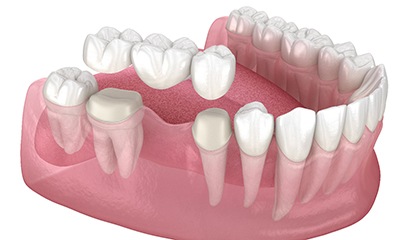 Illustration of a traditional dental bridge