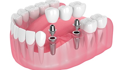 Illustration of an implant bridge