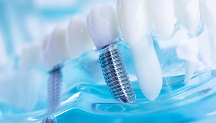 model of dental implants