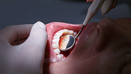 Patient examined with dental mirror