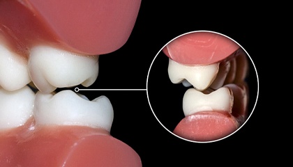 model of teeth grinding