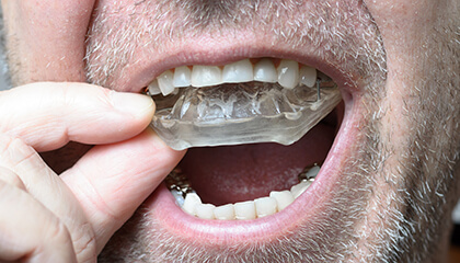 Man placing a nightguard for bruxism treatment