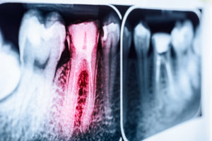 x-ray photo of decayed tooth