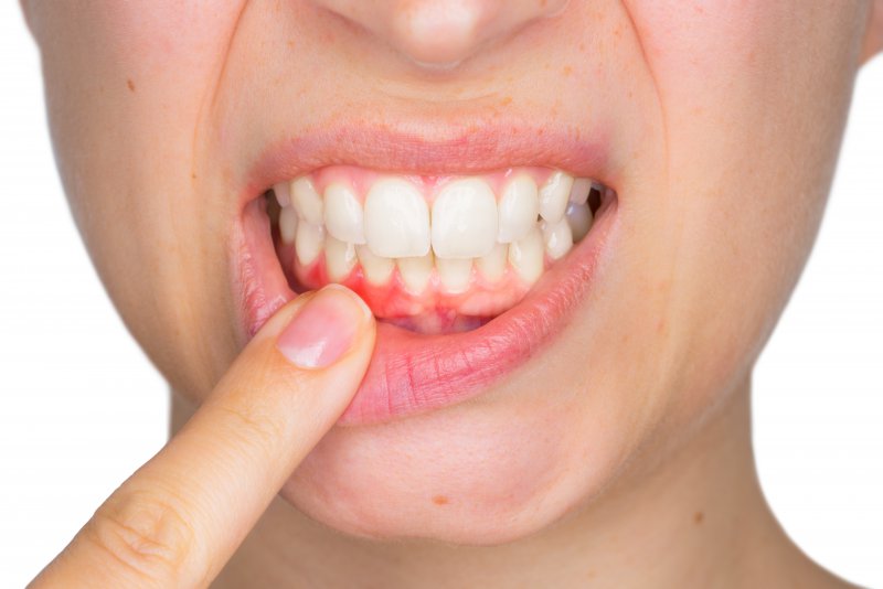 woman showing red spots on gums