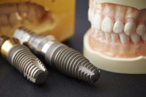 dental implants