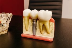 Plastic model used for dental implants