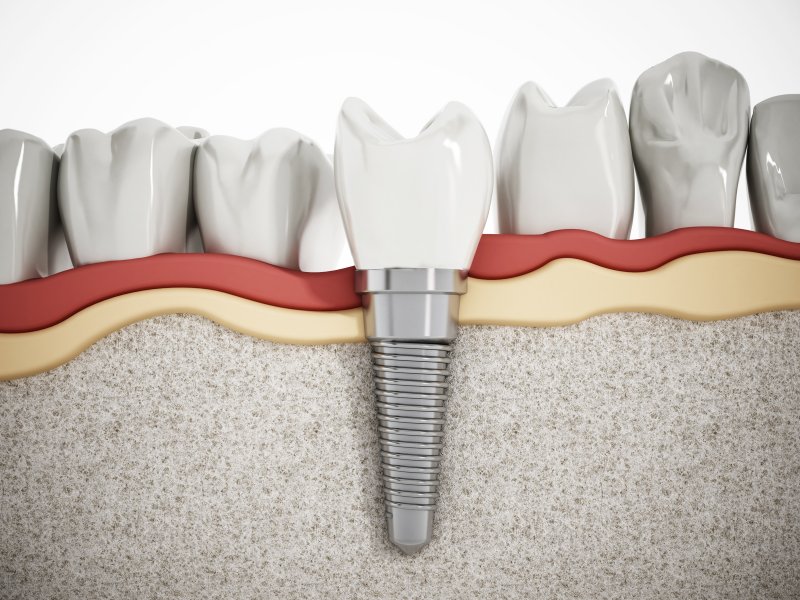 example of dental implants in Melbourne