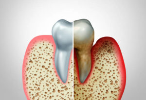 Comparison of healthy gums and gum disease