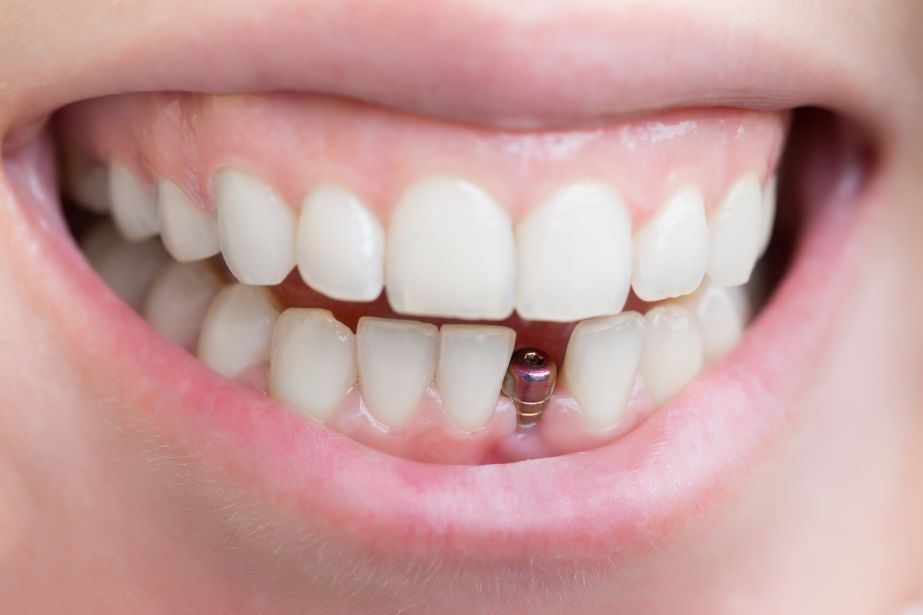 A mouth with a front dental implant