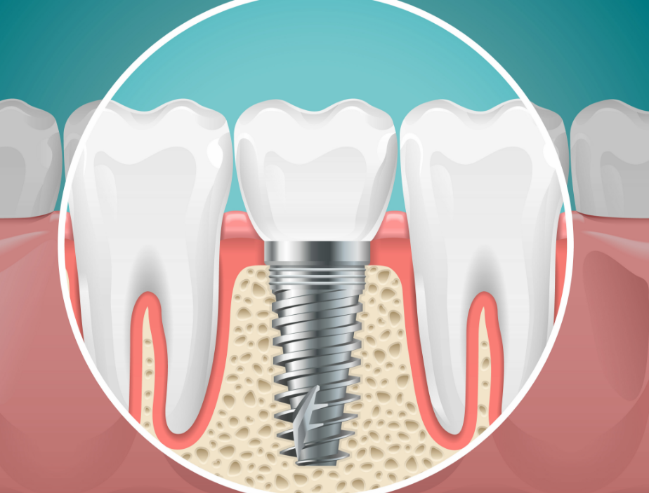 Illustrated cross section of a dental implant