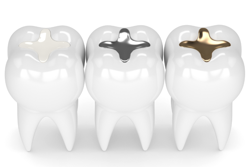 Three teeth with three different filling types -- natural/white, silver, and gold.